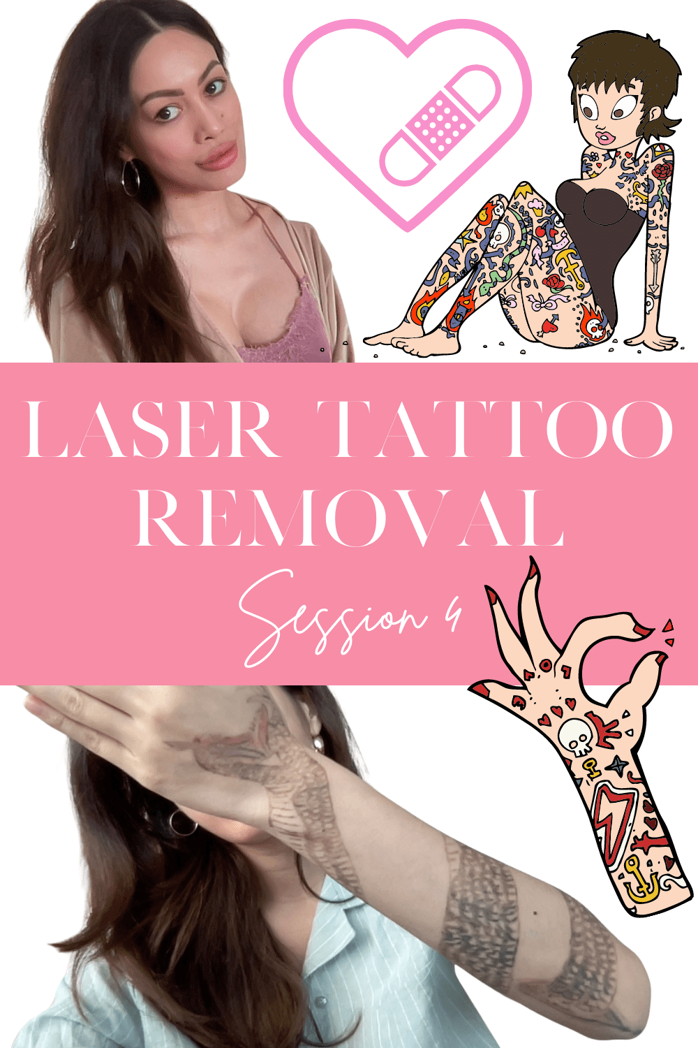 LaserAway Tattoo Removal Session 4